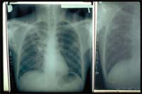 Bragança combate tuberculose
