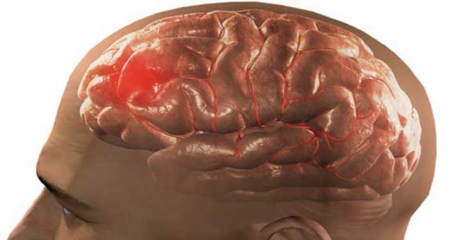 Incidência do AVC está a decrescer